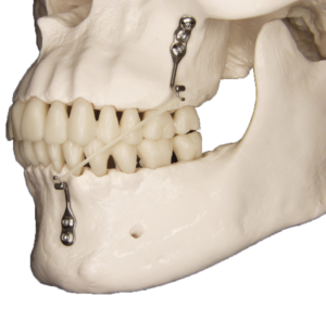 Tita-Link – Manufacturer of the Bollard miniplates